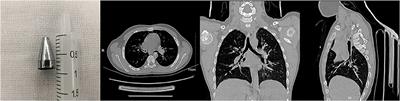 Management of Inedible Airway Foreign Bodies in Pediatric Rigid Bronchoscopy: Experience From a National Children's Regional Medical Center in China